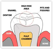 Preventive Dentistry - Fissure Sealant