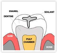 Preventive Dentistry - Fissure Sealant
