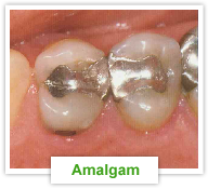 Restoration - Amalgam