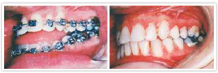 Procedures - Orthodontic Treatment