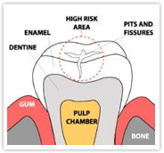 Fissure Sealant