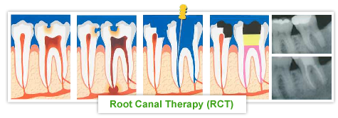 Procedures - Endodontics - Root Canal Therapy